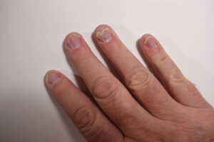 Test die ernst nagelpsoriasis meet is ook nuttig als diagnosticum