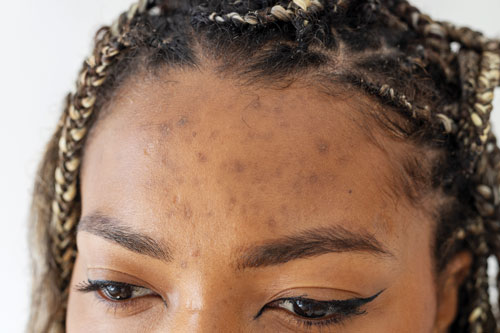 Acne vulgaris bij de donkere huid verdient meer aandacht